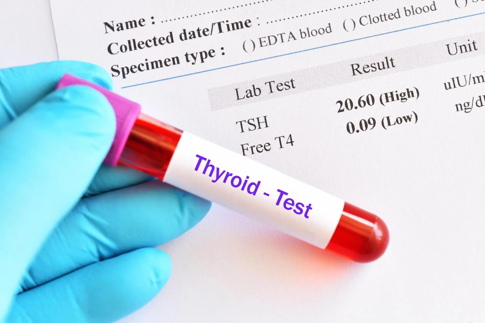 Signs You May Need a Thyroid Test